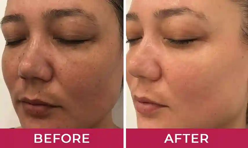 HydraLyft Face Mask HydraLyft Face Mask Reviews