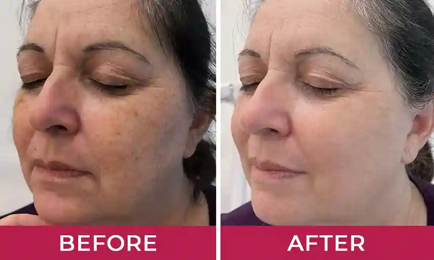 HydraLyft Face Mask HydraLyft Face Mask customer reviews