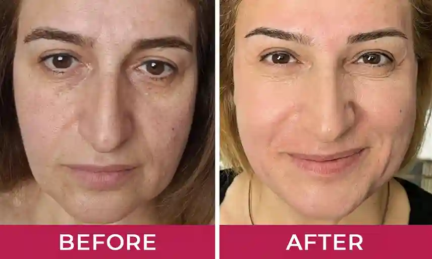 HydraLyft Face Mask HydraLyft Face Mask consumer reviews